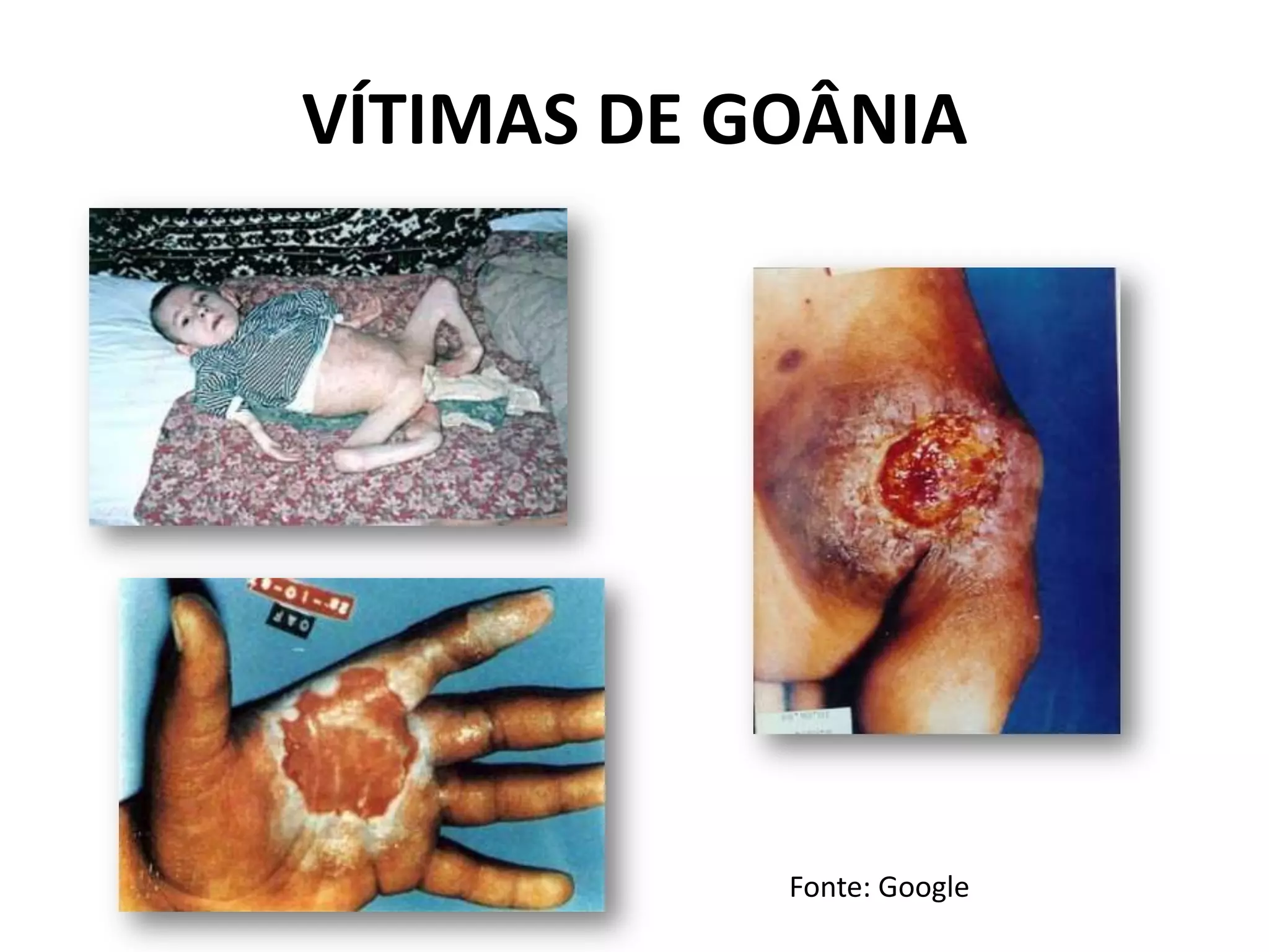 VÍTIMAS DE GOÂNIA
Fonte: Google
 