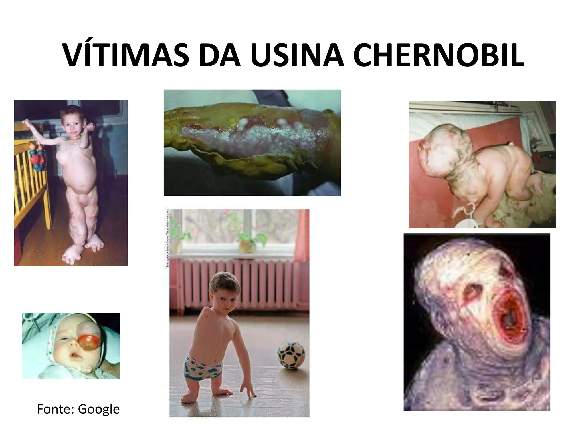 VÍTIMAS DA USINA CHERNOBIL
Fonte: Google
 