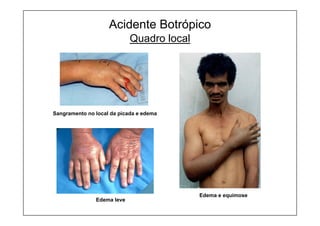 Sangramento no local da picada e edema
Acidente Botrópico
Quadro local
Edema e equimose
Edema leve
 