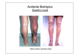 Edema, eritema, equimose, bolhas
Acidente Botrópico
Quadro Local
 