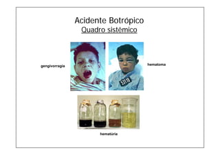 Acidente Botrópico
Quadro sistêmico
gengivorragia
hematúria
hematoma
 