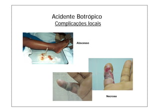 Acidente Botrópico
Complicações locais
Abscesso
Necrose
 