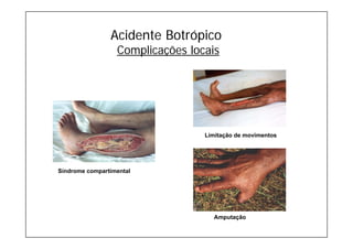 Acidente Botrópico
Complicações locais
Limitação de movimentos
Amputação
Síndrome compartimental
 