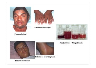 Edema local discreto
Ptose palpebral
Eritema no local da picada
Fáscies miastênica
Rabdomiólise - Mioglobinúria
 