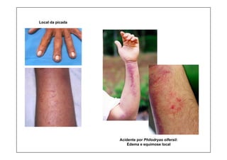 Local da picada
Acidente por Philodryas olfersii:
Edema e equimose local
 
