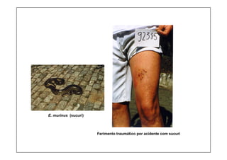 E. murinus (sucuri)
Ferimento traumático por acidente com sucuri
 