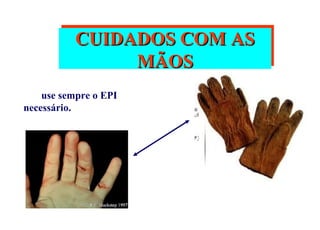 Acidentes maos-dedos seguranca do trabalho | PPS