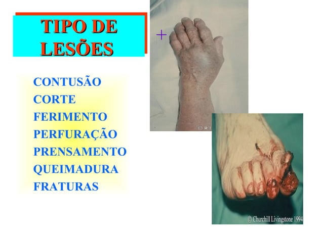 Acidentes maos-dedos seguranca do trabalho | PPS | First Aid | Injuries