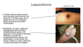 Loxoscelismo
• A lesão cutânea pode evoluir
para necrose seca (escara), em
cerca de 7-12 dias, que, ao se
destacar em 3 a 4 semanas,
deixa uma úlcera de difícil
cicatrização.
• Bombeiro, 31 anos, relata ter
calçado bota pela manhã e
trabalhado por aprox. 12h
seguidas. Ao final desse período,
começou a sentir dor
progressivamente maior, em
queimação, no pé direito. Ao
retirar a bota e a meia, observou
a lesão mostrada na imagem.
Lesão com 7 dias
 