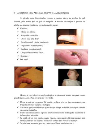 5 ACIDENTES COM ABELHAS, VESPAS E MARIMBONDOS

       As picadas mais disseminadas, comuns e mortais são as de abelhas de mel
comum, pelo menos para os que são alérgicos. A maioria das reações a picadas de
abelha são intensas (ainda que breves) podendo causar:
    Urticária;
    Edema nos lábios;
    Rouquidão ou estridor;
    Sibilos e/ou falta de ar;
    Dor abdominal, vômito ou diarreia;
    Taquicardia ou bradicardia;
    Queda de pressão arterial;
    Choque hipovolêmico fraco;
    Síncope e
    Dor local.




       Mesmo se você não tiver reações alérgicas às picadas de inseto, isso pode causar
grande desconforto. Para aliviar a dor você pode:

    Elevar a parte do corpo que foi picada e colocar gelo ou fazer uma compressa
     fria para diminuir o edema (inchaço);
    Não furar qualquer bolha que possa surgir. Limpe as bolhas com água e sabão
     para evitar infecções;
    Creme de corticosteroide tópico e anti-histamínico oral pode ajudar a controlar a
     inflamação e a coceira;
    Se você estiver com muita coceira (mesmo sem reação alérgica) procure um
     médico para que ele receite a medicação correta para reduzir o inchaço;
    Se o inchaço aumentar, procure cuidados médicos imediatamente e
 