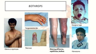 BOTHROPS
Edema, eritema,
equimose, bolhas
Sangramento, dor
Edema e equimose
Necrose
Gengivorragia
Hematoma
 