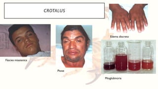 CROTALUS
Edema discreto
Ptose
Fáscies miastenica
Mioglobinúria
 