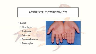 ACIDENTE ESCORPIÔNICO
• Local:
• Dor forte
• Sudorese
• Eritema
• Edema discreto
• Piloereção
 