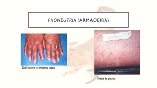 PHONEUTRIA (ARMADEIRA)
Dor, edema e eritema locais
Sinais da picada
 