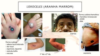 LOXOCELES (ARANHA MARROM)
Forma cutânea
- edema local endurado
- dor local
- equimose, isquemia
- vesícula, bolha
- necrose
Forma cutâneo-hemolítica
- hemólise intravascular
- CIVD
- IRA
1º dia x 2º dia
exantema
ictericia
 