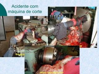 Acidente com 
máquina de corte 
 