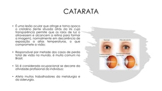 CATARATA
• É uma lesão ocular que atinge e torna opaco
o cristalino (lente situada atrás da íris cuja
transparência permite que os raios de luz o
atravessem e alcancem a retina para formar
a imagem), normalmente em decorrência de
exposição a altas temperaturas, o que
compromete a visão;
• Responsável por metade dos casos de perda
total de visão no mundo, é muito comum no
Brasil;
• Só é considerada ocupacional se decorre da
atividade profissional do indivíduo;
• Afeta muitos trabalhadores da metalurgia e
da siderurgia.
 