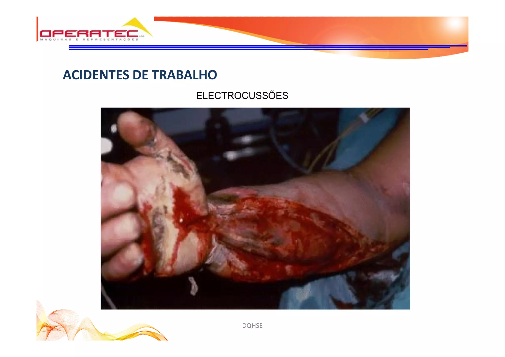DQHSE
ACIDENTES DE TRABALHO
ELECTROCUSSÕES
 