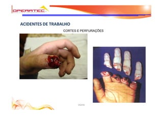 DQHSE
ACIDENTES DE TRABALHO
CORTES E PERFURAÇÕES
 