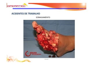 DQHSE
ACIDENTES DE TRABALHO
ESMAGAMENTO
 