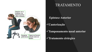 TRATAMENTO
Epistaxe Anterior
✓Cauterização
✓Tamponamento nasal anterior
✓Tratamento cirúrgico
 
