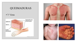 QUEIMADURAS
✓1° Grau
 