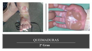 QUEIMADURAS
2º Grau
 