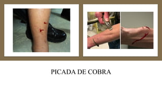 PICADA DE COBRA
 