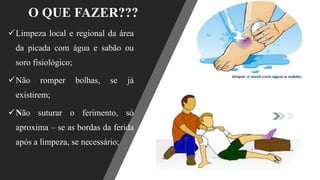 O QUE FAZER???
✓Limpeza local e regional da área
da picada com água e sabão ou
soro fisiológico;
✓Não romper bolhas, se já
existirem;
✓Não suturar o ferimento, só
aproxima – se as bordas da ferida
após a limpeza, se necessário;
 