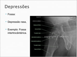  Fossa:
 Depressão rasa,
 Exemplo: Fossa
intertrocântérica.
 
