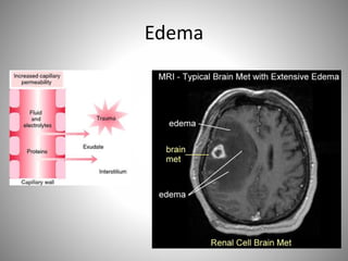 Edema
 