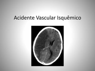 Acidente Vascular Isquêmico
 