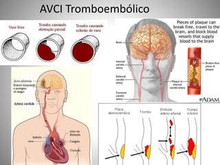 AVCI Tromboembólico
 