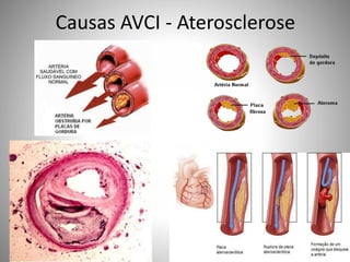 Causas AVCI - Aterosclerose
 