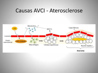Causas AVCI - Aterosclerose
 