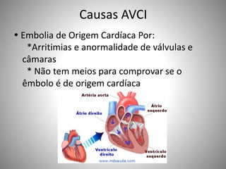 Causas AVCI
 Embolia de Origem Cardíaca Por:
*Arritimias e anormalidade de válvulas e
câmaras
* Não tem meios para comprovar se o
êmbolo é de origem cardíaca
 