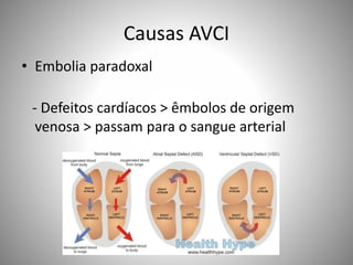 Causas AVCI
• Embolia paradoxal
- Defeitos cardíacos > êmbolos de origem
venosa > passam para o sangue arterial
 