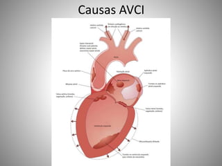 Causas AVCI
 