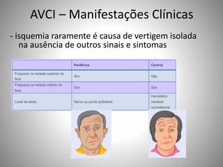 AVCI – Manifestações Clínicas
- isquemia raramente é causa de vertigem isolada
na ausência de outros sinais e sintomas
 