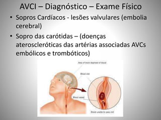 AVCI – Diagnóstico – Exame Físico
• Sopros Cardíacos - lesões valvulares (embolia
cerebral)
• Sopro das carótidas – (doenças
ateroscleróticas das artérias associadas AVCs
embólicos e trombóticos)
 