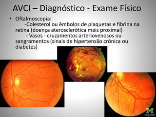 AVCI – Diagnóstico - Exame Físico
• Oftalmoscopia:
-Colesterol ou êmbolos de plaquetas e fibrina na
retina (doença aterosclerótica mais proximal)
- Vasos - cruzamentos arteriovenosos ou
sangramentos (sinais de hipertensão crônica ou
diabetes)
 