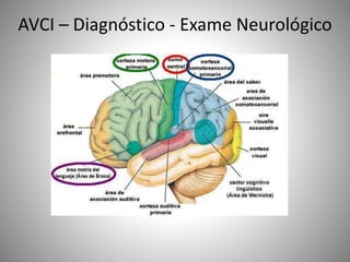 AVCI – Diagnóstico - Exame Neurológico
 