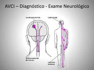 AVCI – Diagnóstico - Exame Neurológico
 