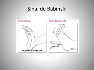 Sinal de Babinski
 