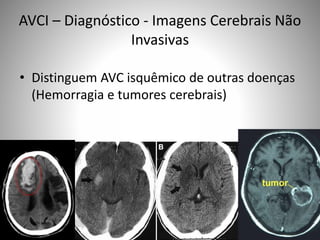 AVCI – Diagnóstico - Imagens Cerebrais Não
Invasivas
• Distinguem AVC isquêmico de outras doenças
(Hemorragia e tumores cerebrais)
 