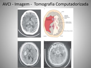 AVCI - Imagem - Tomografia Computadorizada
 