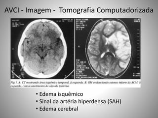 • Edema isquêmico
• Sinal da artéria hiperdensa (SAH)
• Edema cerebral
AVCI - Imagem - Tomografia Computadorizada
 