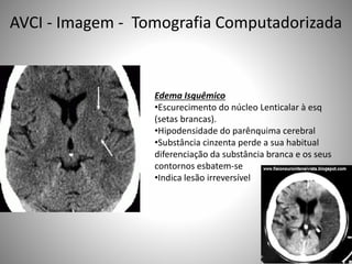 Edema Isquêmico
•Escurecimento do núcleo Lenticalar à esq
(setas brancas).
•Hipodensidade do parênquima cerebral
•Substância cinzenta perde a sua habitual
diferenciação da substância branca e os seus
contornos esbatem-se
•Indica lesão irreversível
AVCI - Imagem - Tomografia Computadorizada
 