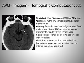 Sinal da Artéria Hiperdensa (SAH) da ACM esq.
•presença, numa TAC sem contraste, de vasos
hiperdensos.
•consequência do facto dos coágulos possuírem
maior absorção em TAC do que o sangue em
movimento, sendo visíveis como zonas
hiperdensas ao longo do trajecto das artérias
intracranianas.
•Mais frequente na artéria cerebral média
(também possível SAH das artérias carótida
interna e cerebral posterior)
AVCI - Imagem - Tomografia Computadorizada
 