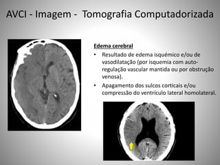 Edema cerebral
• Resultado de edema isquémico e/ou de
vasodilatação (por isquemia com auto-
regulação vascular mantida ou por obstrução
venosa).
• Apagamento dos sulcos corticais e/ou
compressão do ventrículo lateral homolateral.
AVCI - Imagem - Tomografia Computadorizada
 
